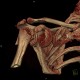 Comminuted fracture of the head of humerus, VRT: CT - Computed tomography